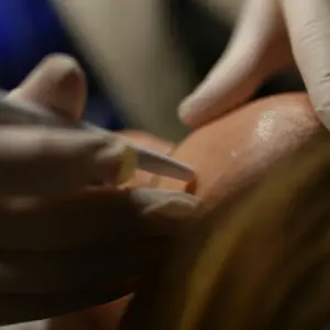 formation-esthetique-microneedling-soin-du-visage